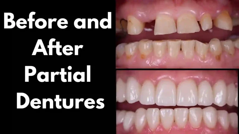 Before and After Partial Dentures
