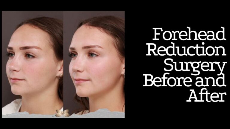 Forehead Reduction Surgery Before and After