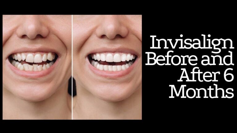 Invisalign Before and After 6 Months