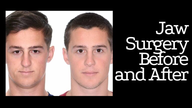 Jaw Surgery Before and After