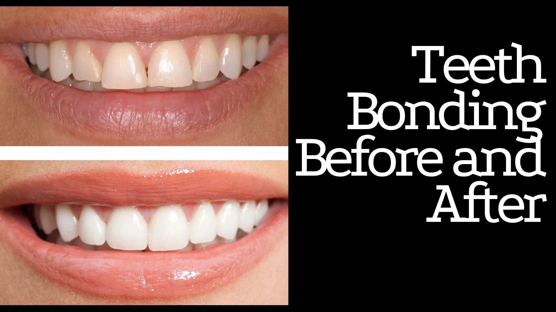 Teeth Bonding Before and After